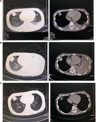 Successful treatment with HLA-matched peripheral hematopoietic stem cell transplantation for very severe hepatitis-associated aplastic anemia complicated with multidrug-resistant bacterial and fungal infections: A case report